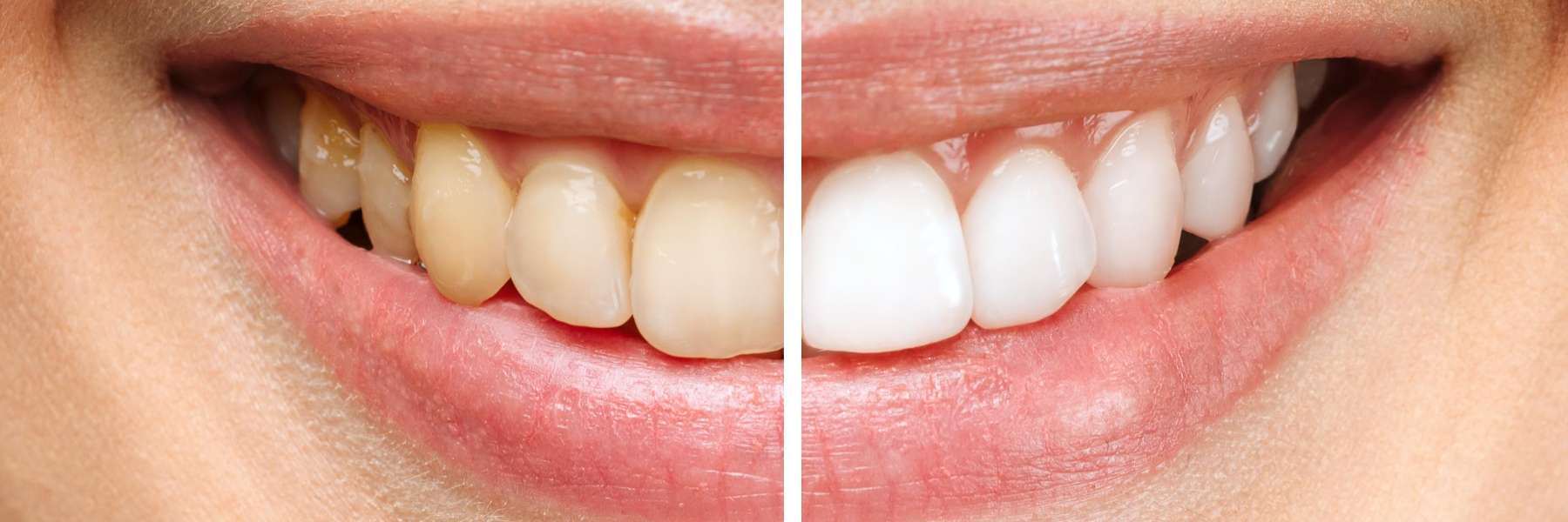 Before and after of teeth whitening, west chester ohio