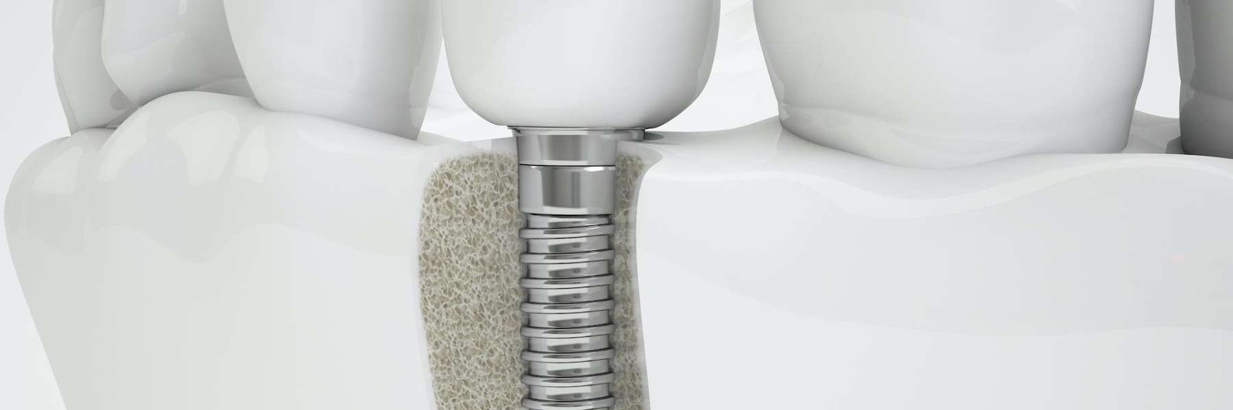 Dental implant in mouth, west chester oh