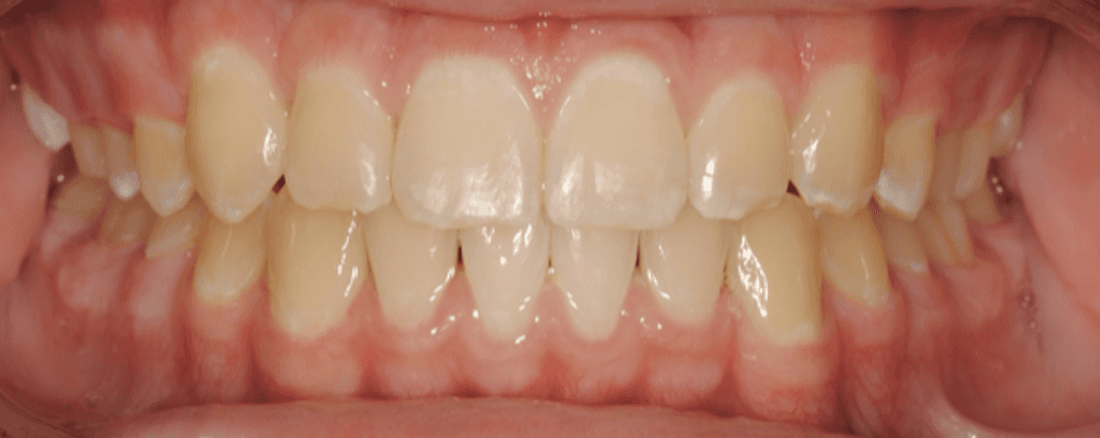 After traditional braces, west chester oh