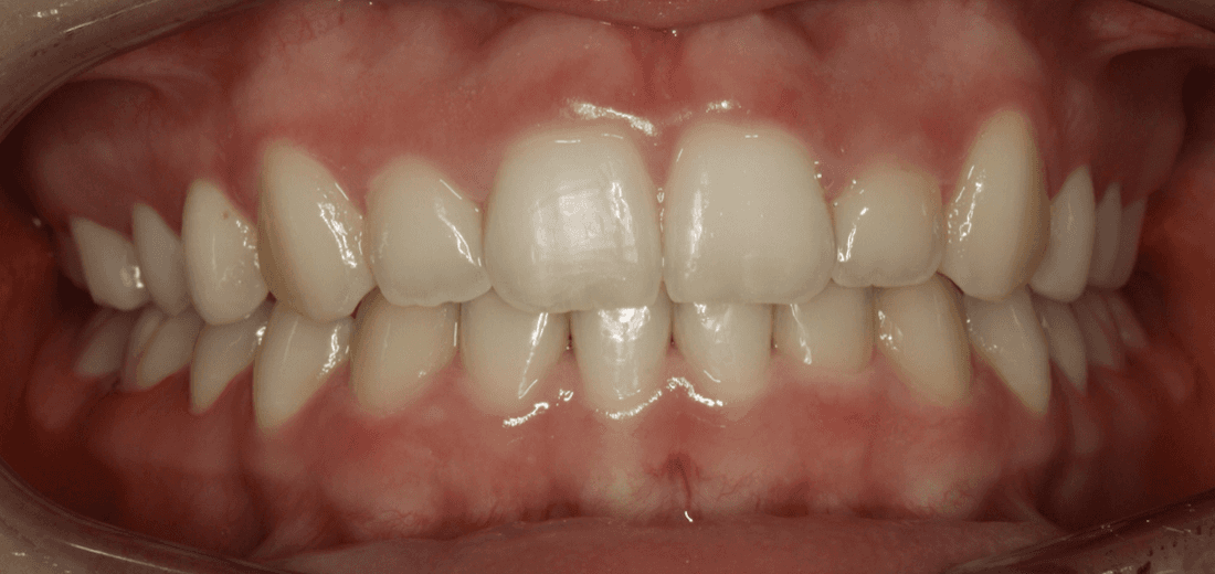Close up of mouth after tradtional braces, west chester oh
