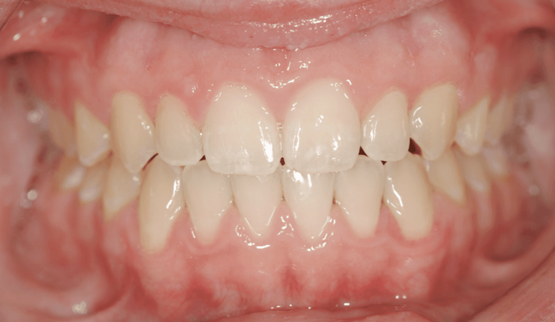 Close up of full mouth after traditional braces, west chester oh