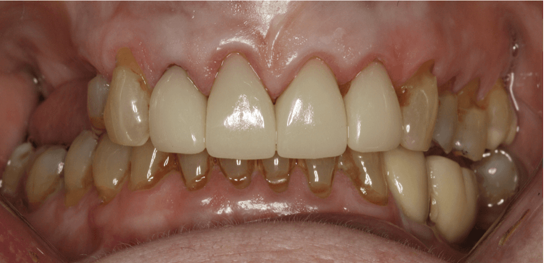 Close up of mouth after Anterior Single Visit Crowns, west chester oh