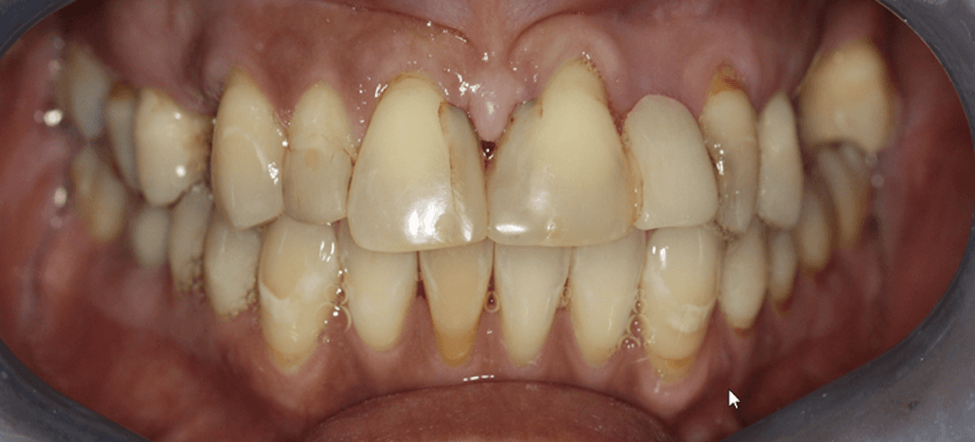 Close up of mouth before Anterior Crown and Bridges, west chester oh