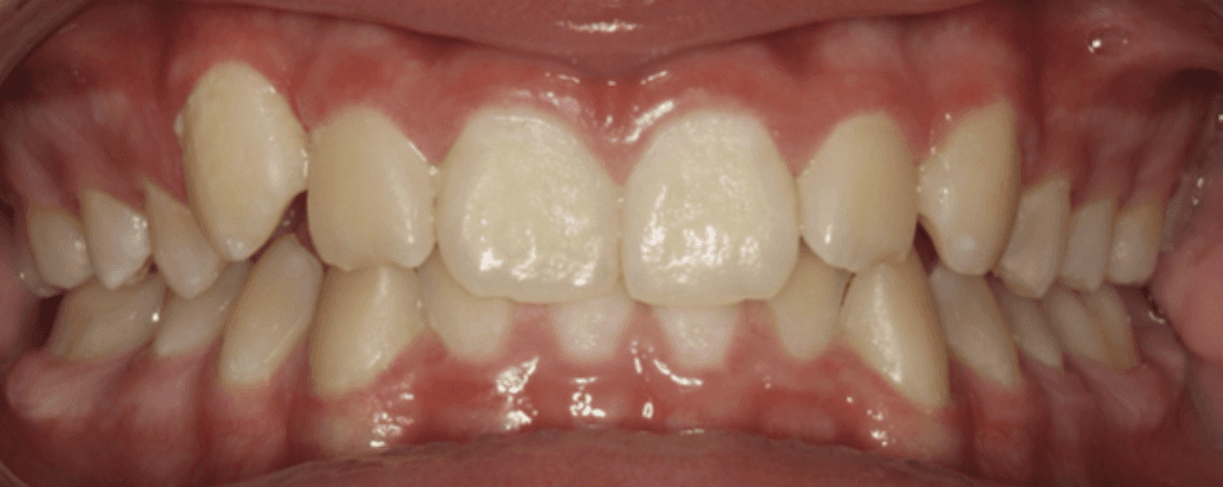 Before traditional braces, west chester oh