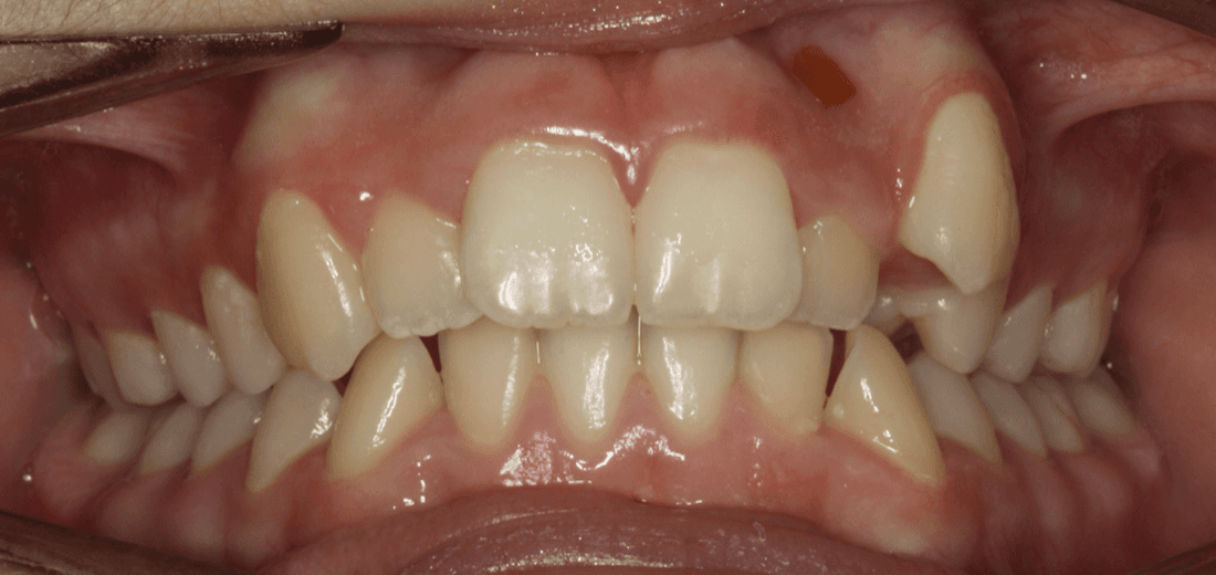 Close up of mouth before tradtional braces, west chester oh