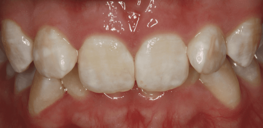 Front teeth before traditional braces, west chester oh