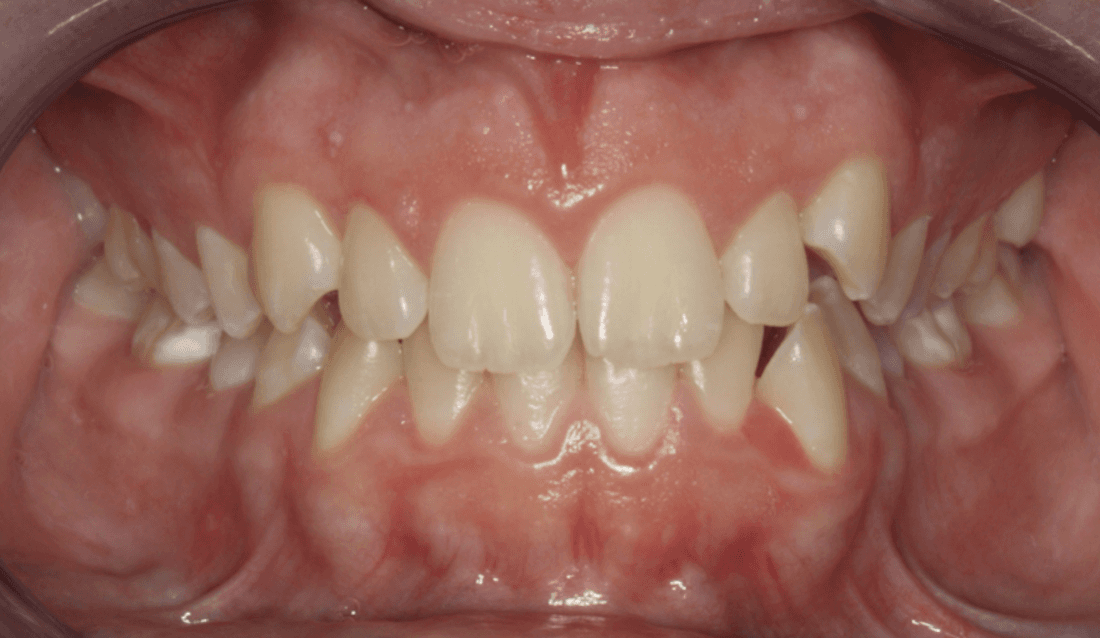 Close up of full mouth before traditional braces, west chester oh