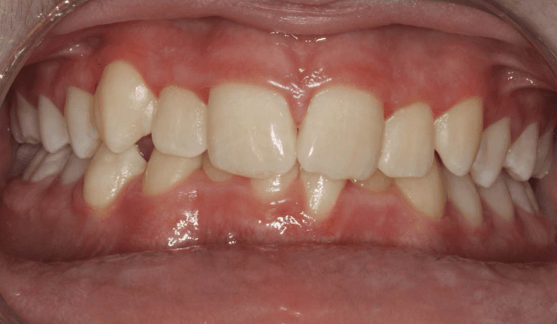 Mouth before traditional braces, west chester oh