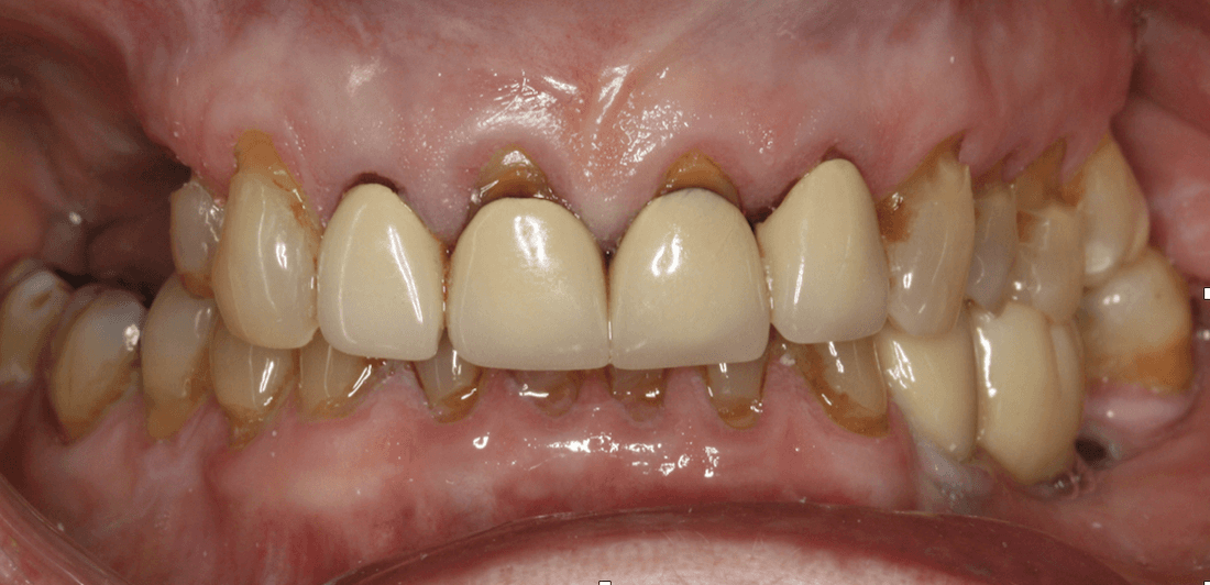 Close up of mouth before Anterior Single Visit Crowns, west chester oh