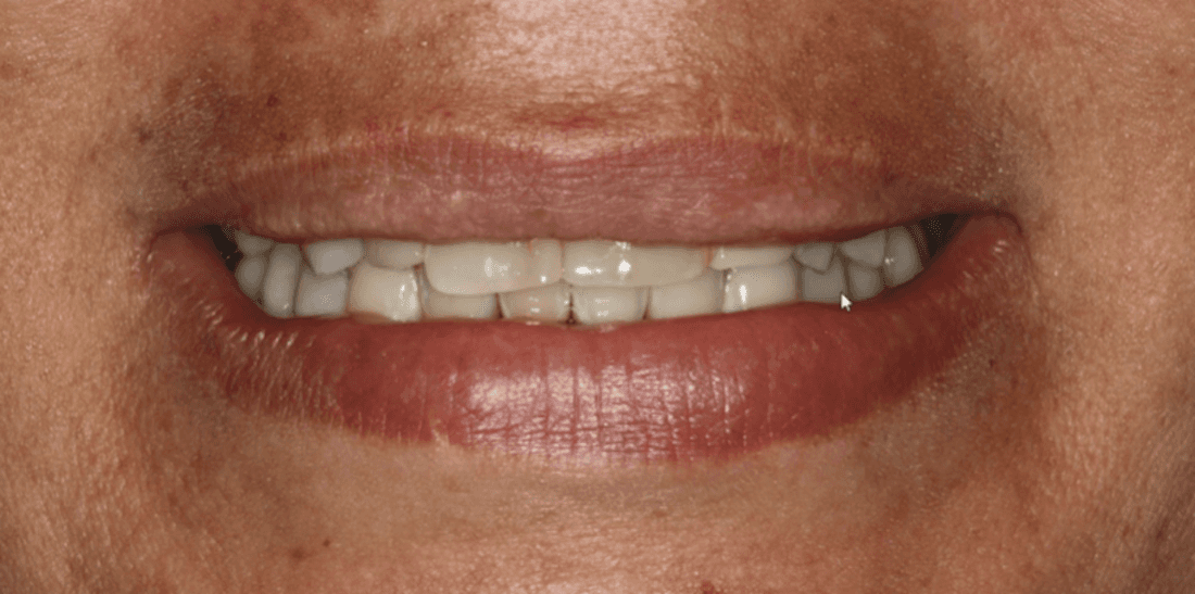 Full mouth view before Anterior Crown and Bridges, west chester oh