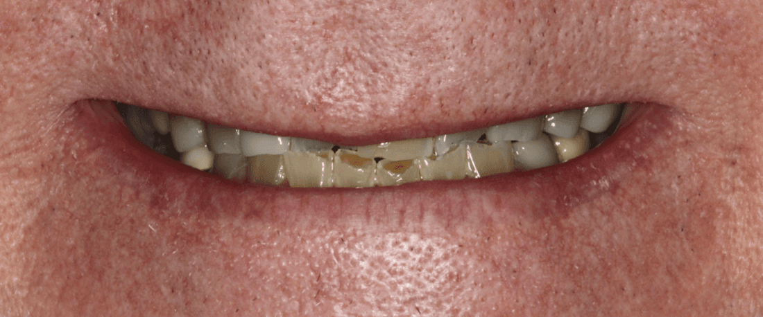 Mouth smiling before anterior single visit crowns, west chester oh