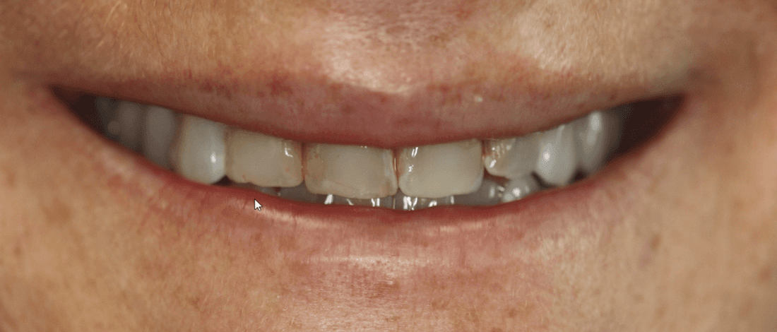 mouth before anterior single visit crowns, west chester oh