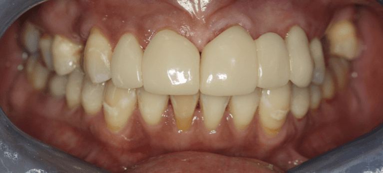 Close up of mouth after Anterior Crown and Bridges, west chester oh