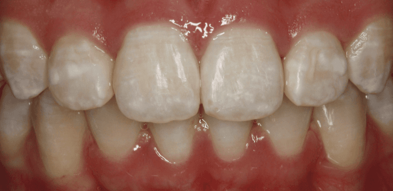 Front teeth after traditional braces, west chester oh