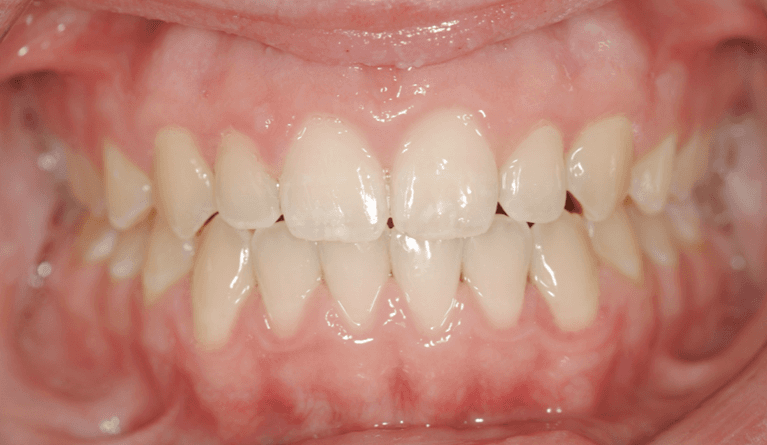 Close up of full mouth after traditional braces, west chester oh