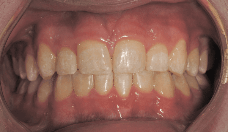 Mouth after traditional braces, west chester oh