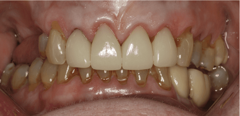 Close up of mouth after Anterior Single Visit Crowns, west chester oh