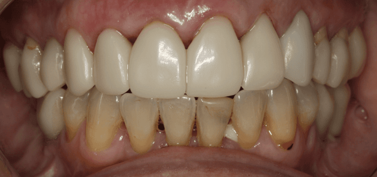 Teeth after Anterior Single Visit Crowns, west chester oh