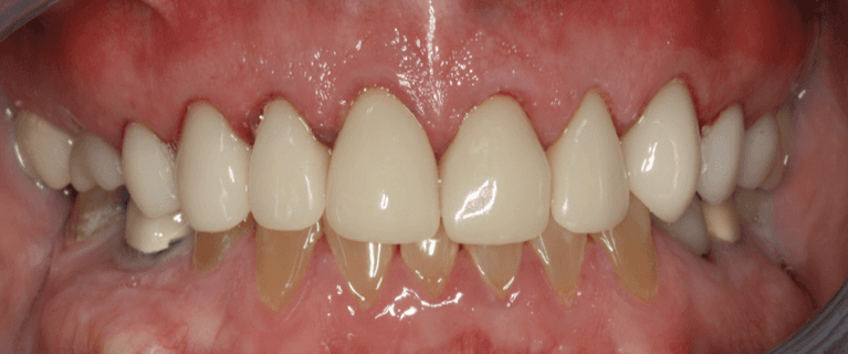 Full teeth after anterior single visit crowns, west chester oh