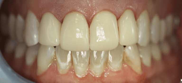 Close up of mouth after anterior single visit crowns, west chester oh