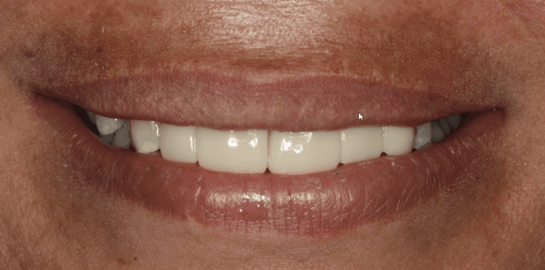 Full mouth view after Anterior Crown and Bridges, west chester oh