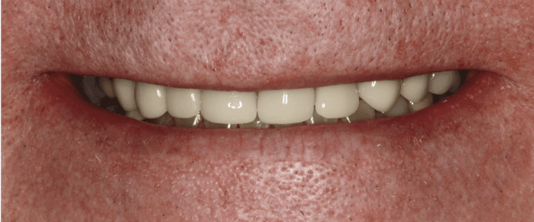 Mouth smiling after anterior single visit crowns, west chester oh