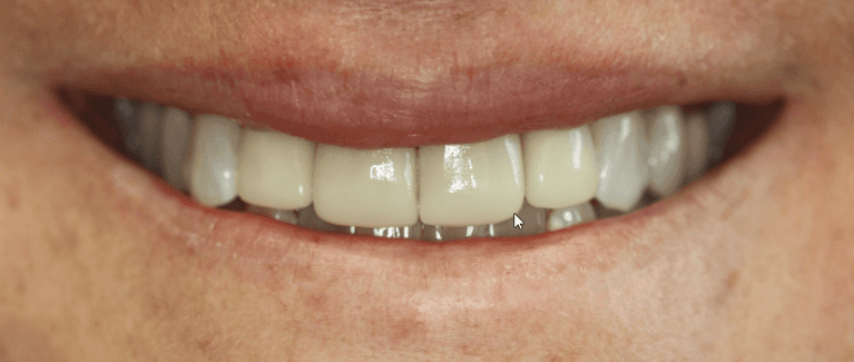 mouth after anterior single visit crowns, west chester oh