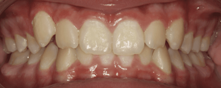 Traditional-Braces-Before-Image