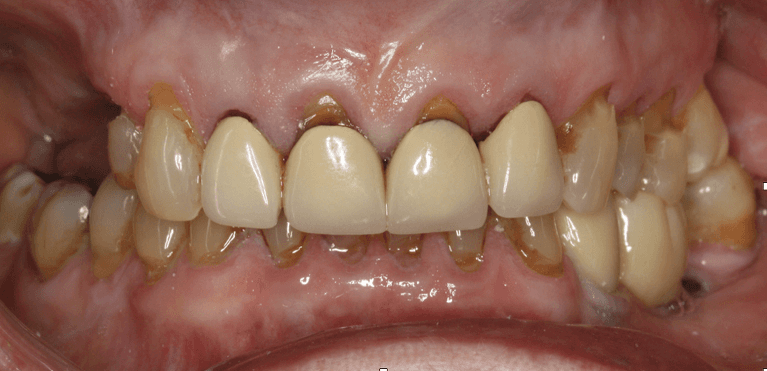 Close up of mouth before Anterior Single Visit Crowns, west chester oh