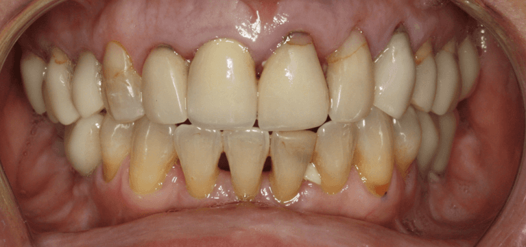 Teeth before Anterior Single Visit Crowns, west chester oh