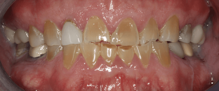 Full teeth before anterior single visit crowns, west chester oh