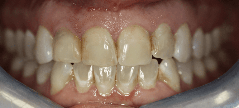 Close up of mouth before anterior single visit crowns, west chester oh